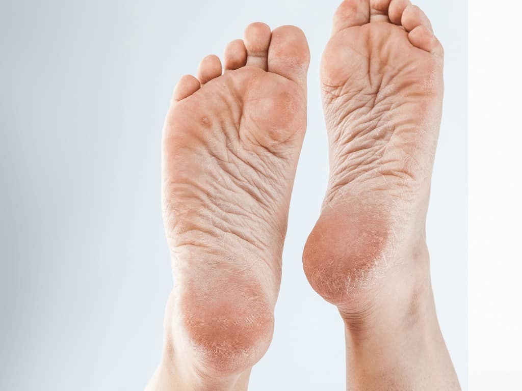Nguyên nhân bị nứt gót chân thường xuyên