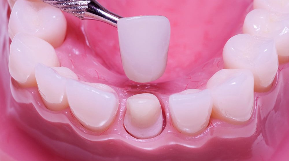 Tại sao phải bảo quản và chăm sóc răng bọc sứ